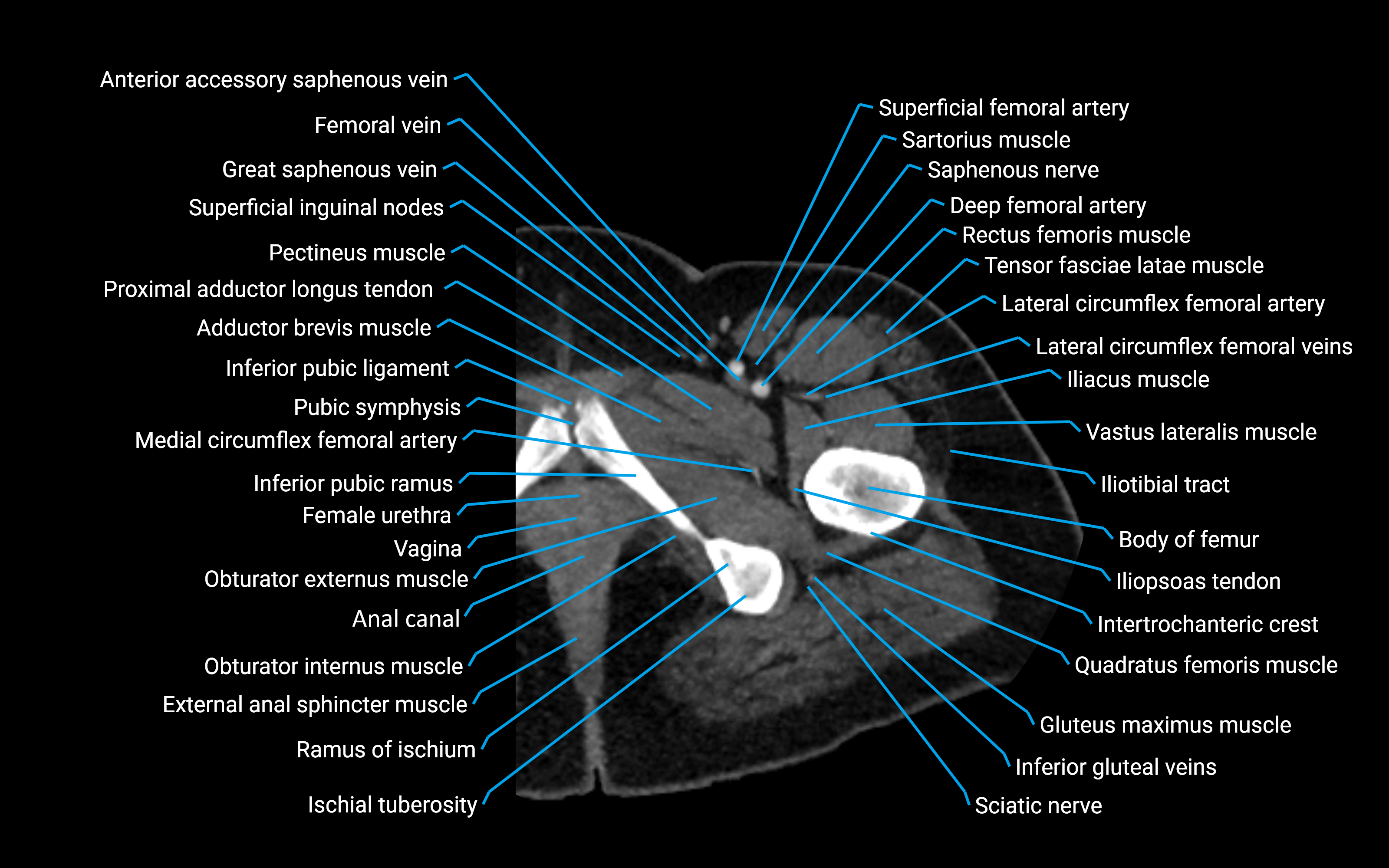 CT Hip axial cross sectional anatomy labelled image 15 (2).png